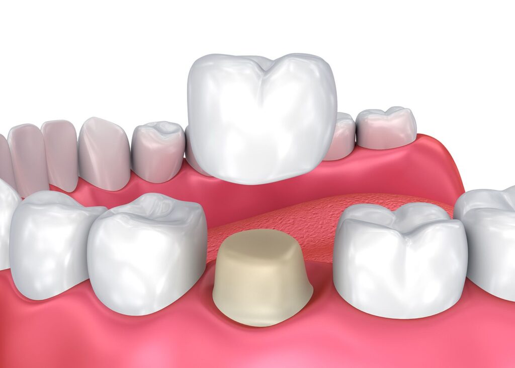 Worried about getting a dental crown? Here’s your guide