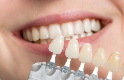 Dazzling Smile Renewal Through Complete Dentures
