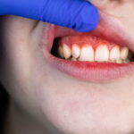 Periodontal Disease Types: Identifying and Addressing Variants
