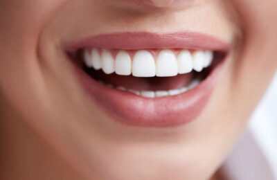 Are Dental Veneers Made For Me? 