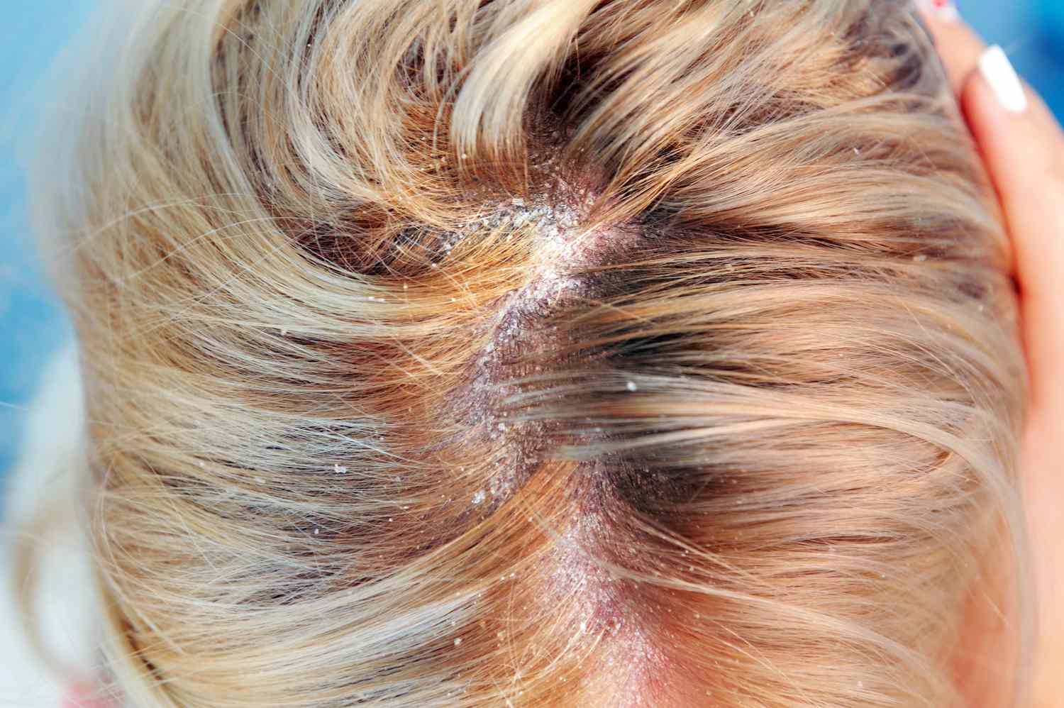 How Often Should I Wash My Hair to Prevent Dandruff?